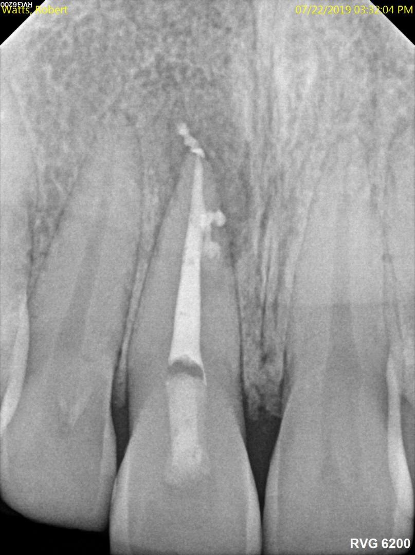 Interesting Endodontic Cases Reno Endodontics