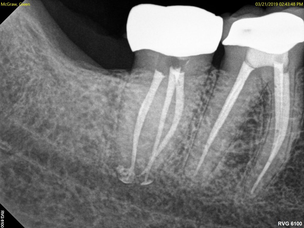 Interesting Endodontic Cases Reno Endodontics