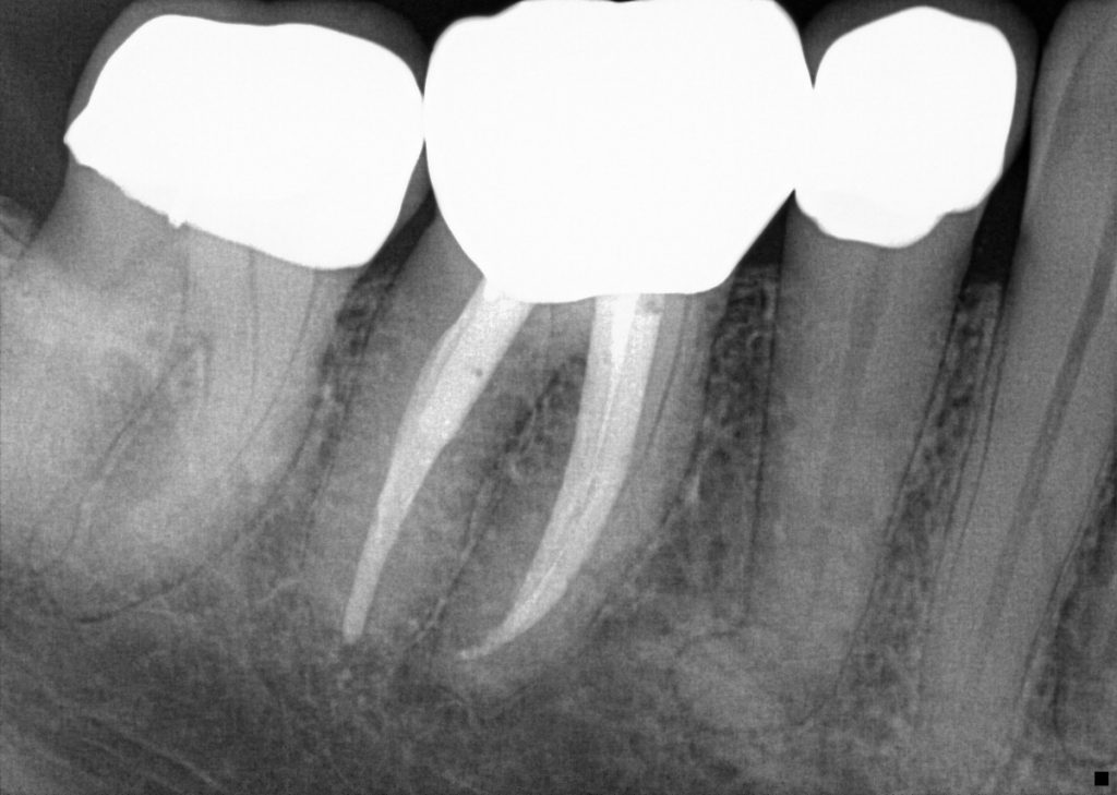 Interesting Endodontic Cases Reno Endodontics